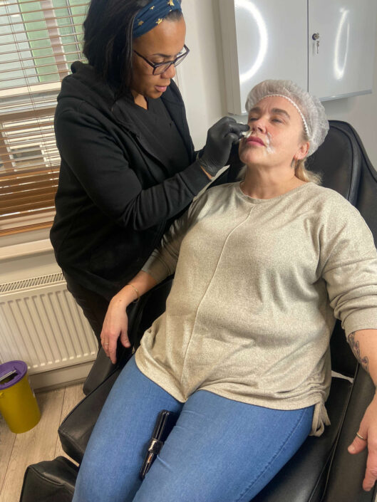 lip-fillers-birmingham